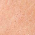 Chest Capillaries After