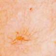 Chest Capillaries Before