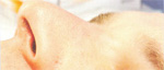 Spider Vein After